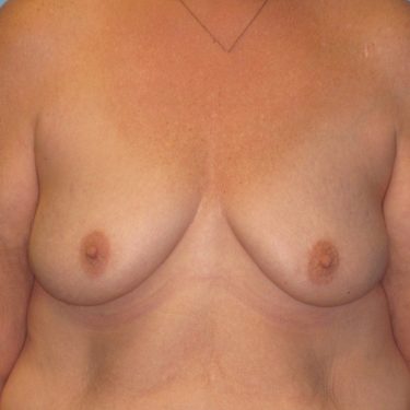 Breast Augmentation & Lift Before Patient 7