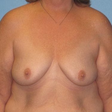 Breast Lift Before Patient 5