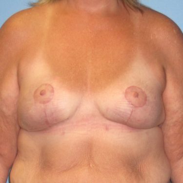 Breast Lift After Patient 5