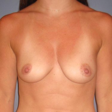 Breast Augmentation Before Patient 29