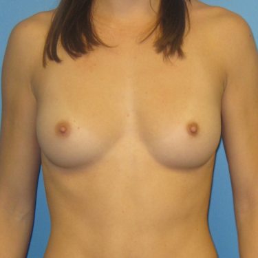 Breast Augmentation Before Patient 28
