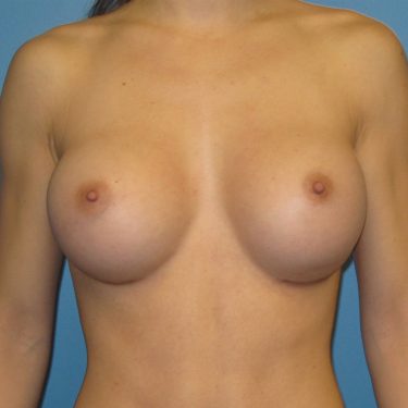 Breast Augmentation After Patient 28