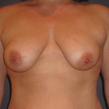 Dual-plane technique Before Patient 14