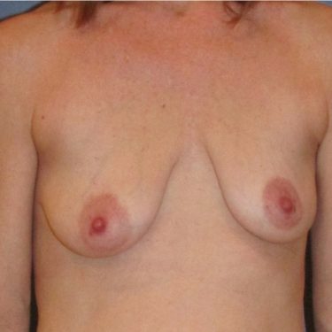 Breast Lift Before Patient 4