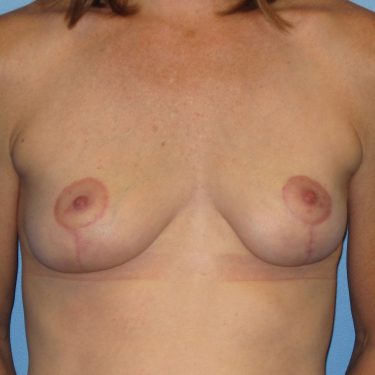 Breast Lift After Patient 4
