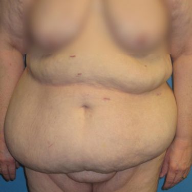 Tummy Tuck Before Patient 29