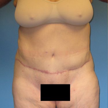 Tummy Tuck After Patient 29