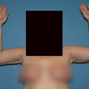 Surgery After Weight Loss After Patient 18