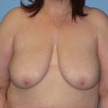 Surgery After Weight Loss Before Patient 17