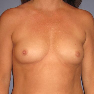 Breast Augmentation Before Patient 25