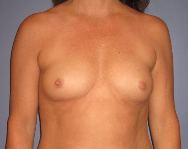 Breast Augmentation Before Patient 1