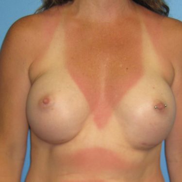 Breast Augmentation After Patient 25