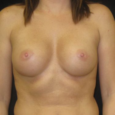 Breast Augmentation After Patient 24