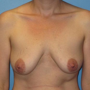 Breast Lift Before Patient 2