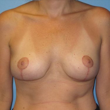 Breast Lift After Patient 2