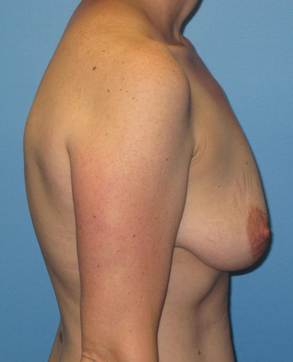 Breast Lift Before Patient 3