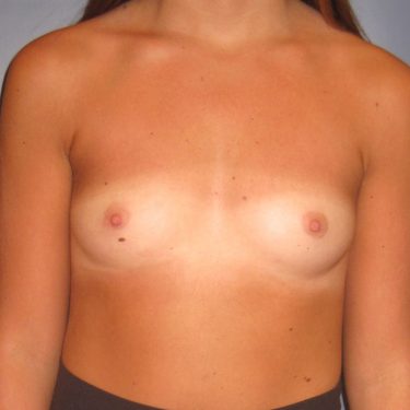 Breast Augmentation Before Patient 23