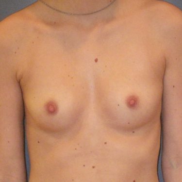 Pectus deformity Before Patient 5