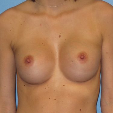 Pectus deformity After Patient 5