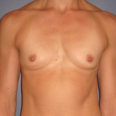 Breast Augmentation Before Patient 20