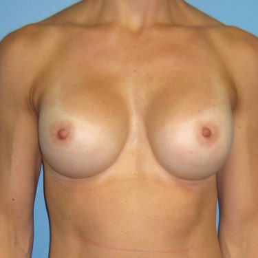 Breast Augmentation After Patient 20