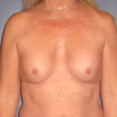 Revision of Others' Work Before Patient 5