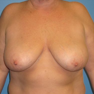 Breast Lift Before Patient 1