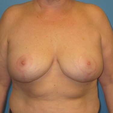 Breast Lift After Patient 1
