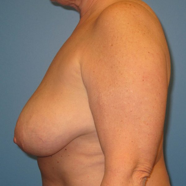 Breast Lift Before Patient 3