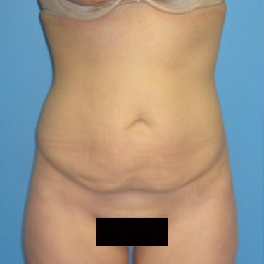 Tummy Tuck Before Patient 28