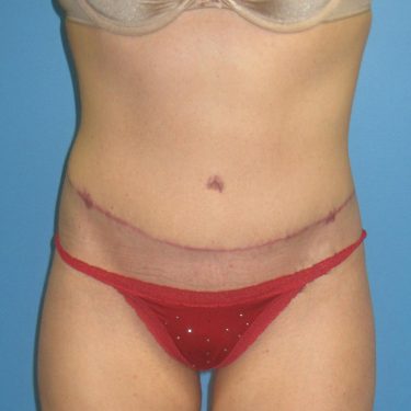 Tummy Tuck After Patient 28