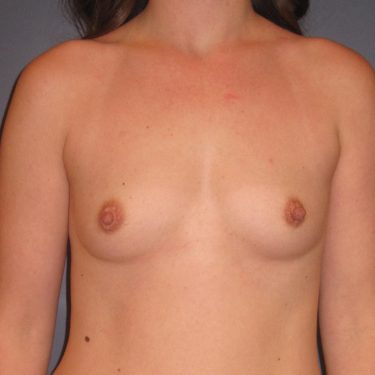 Breast Augmentation Before Patient 18