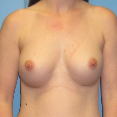 Breast Augmentation After Patient 18