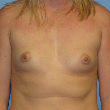 Breast Augmentation Before Patient 16