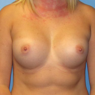 Breast Augmentation After Patient 16