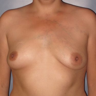 Subglandular Before Patient 28