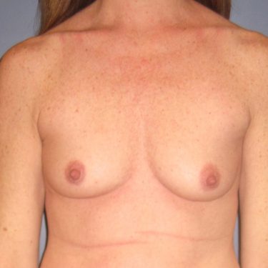Breast Augmentation Before Patient 15
