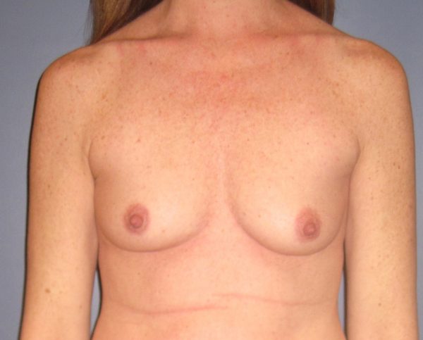 Breast Augmentation Before Patient 1