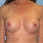 Breast Augmentation After Patient Thumbnail 1