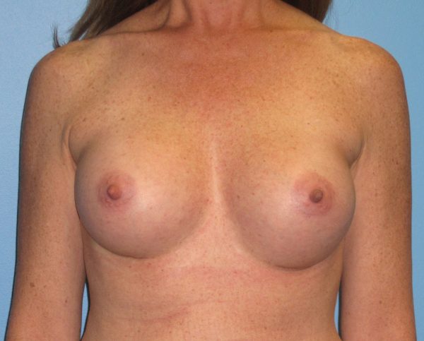 Breast Augmentation After Patient 1