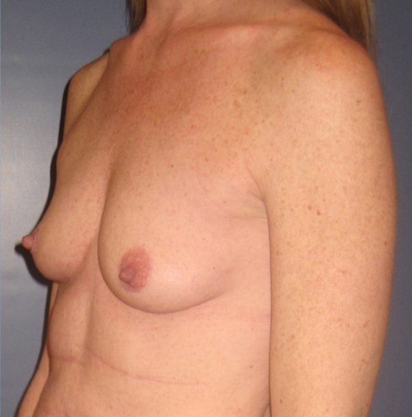 Breast Augmentation Before Patient 2