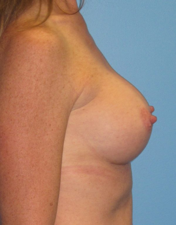 Breast Augmentation After Patient 3