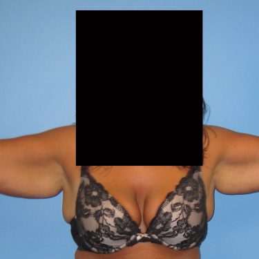 Brachioplasty Before Patient 4