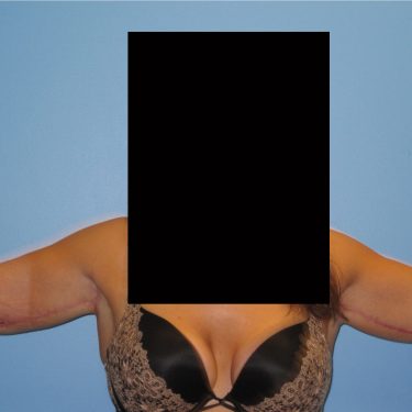 Brachioplasty After Patient 4