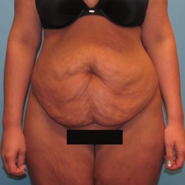 Tummy Tuck Before Patient 2