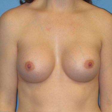 Breast Augmentation After Patient 14