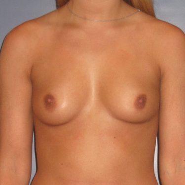 Breast Augmentation Before Patient 13