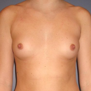 Breast Augmentation Before Patient 12