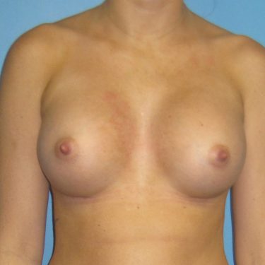 Breast Augmentation After Patient 12