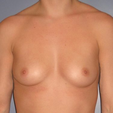 Breast Augmentation Before Patient 11